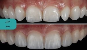 4 مورد از مهم‌ترین عوارض کامپوزیت دندان