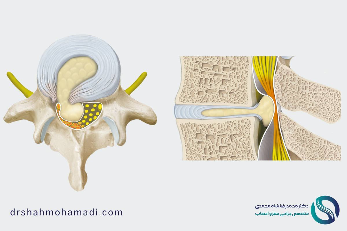 دکتر شاه محمدی متخصص جراحی دیسک کمر در تهران دکتر شاه محمدی متخصص جراحی دیسک کمر در تهران